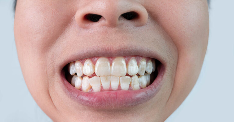 person showing their teeth that has various white spots on their teeth