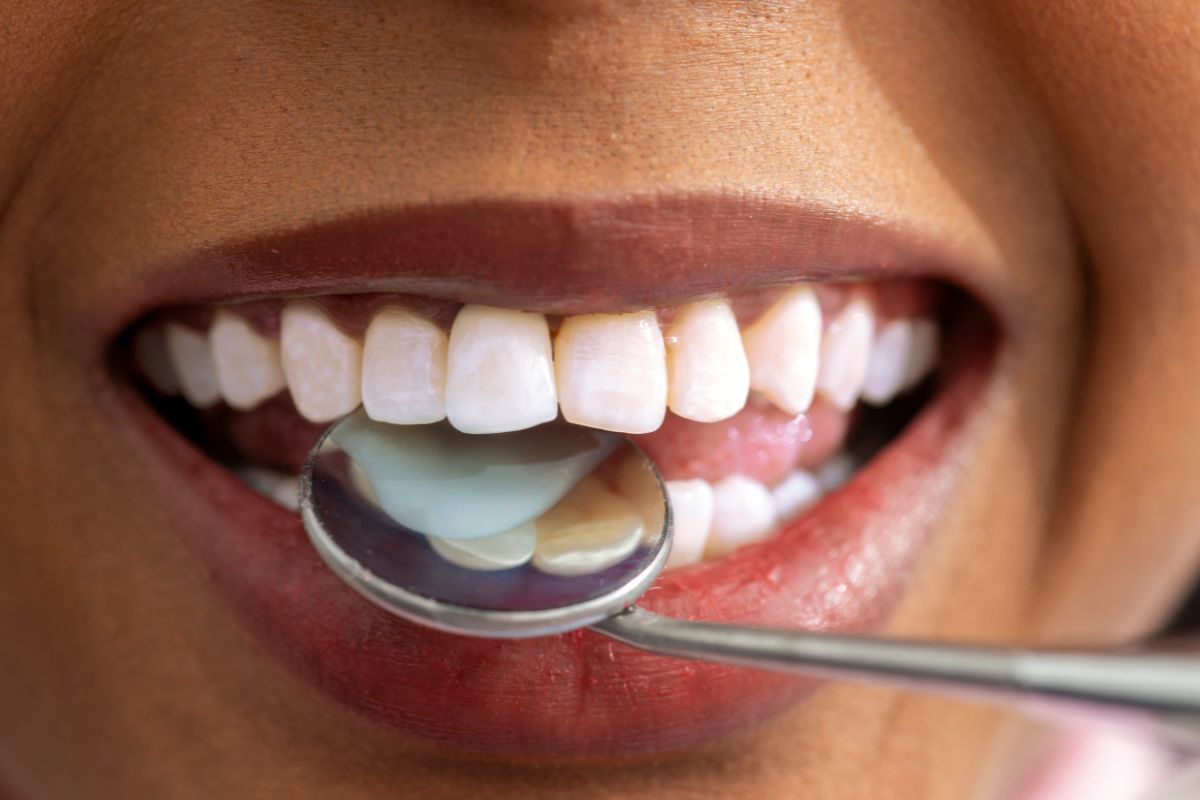 Early Signs of Tooth Erosion You Should Never Ignore