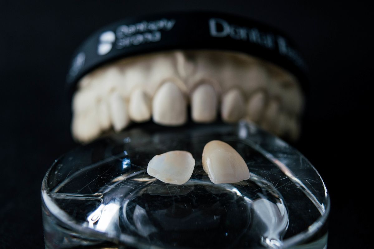 Can a Broken Dental Crown Be Repaired? Expert Advice
