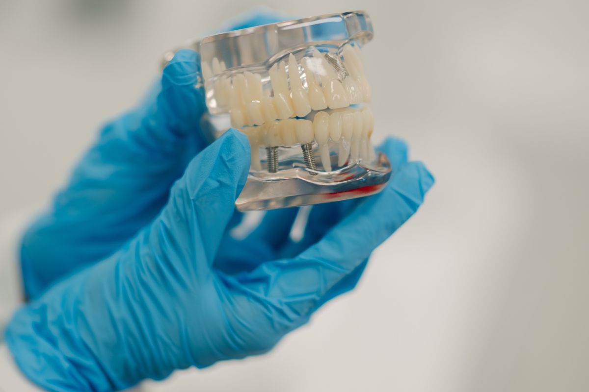 Can I Use One Implant to Replace Two Molars?