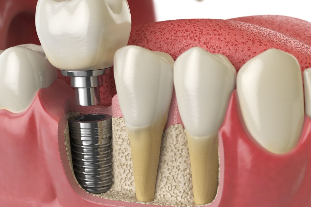 How to Maintain Proper Oral Hygiene After Getting Dental Implants