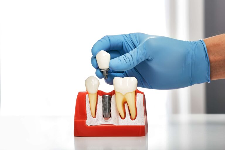 Dental implant model showing the implant post and crown placement next to natural teeth for tooth replacement comparison
