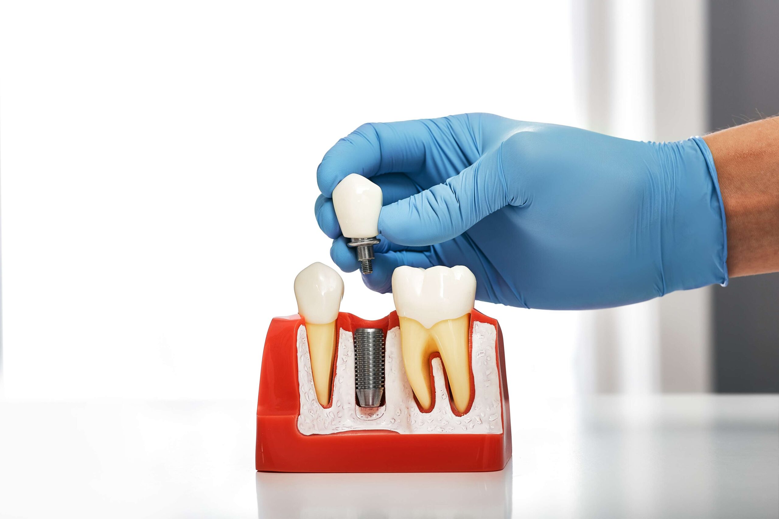 Dental Implants vs. Dental Bridges: Which Tooth Replacement Option Is Better?
