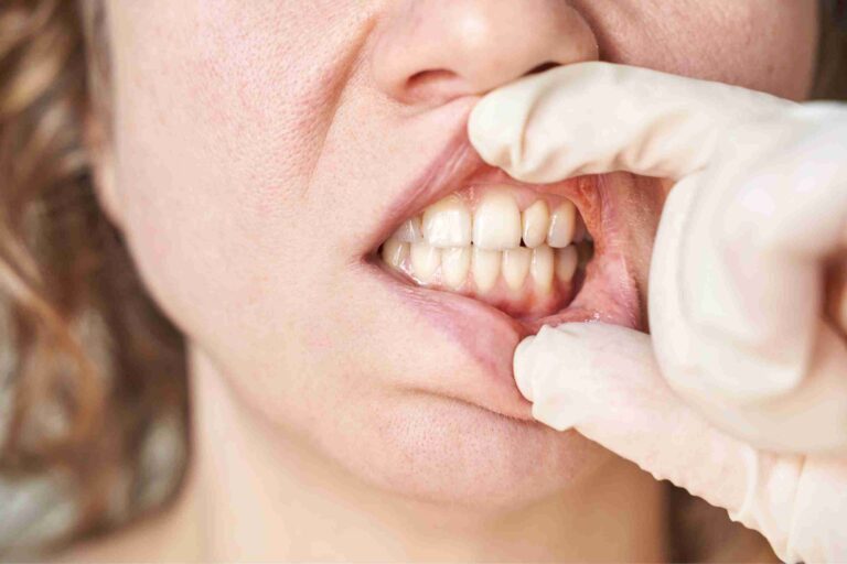 Women showing gum problem in close up