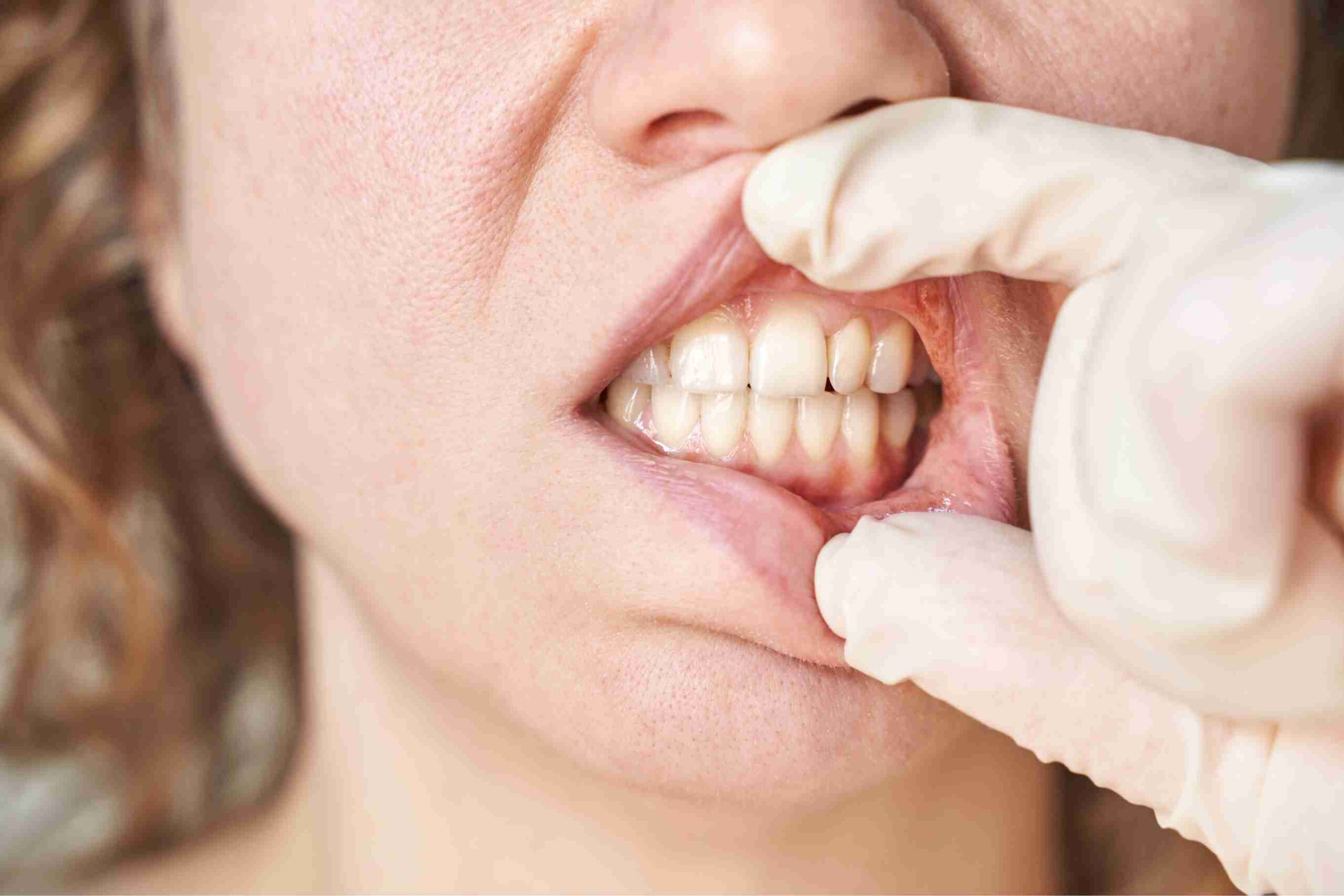 Can ZYN or Nicotine Pouches Cause Gum Recession?