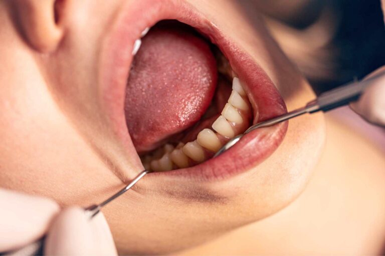 Dental floss being used to clean between lower teeth during an examination.