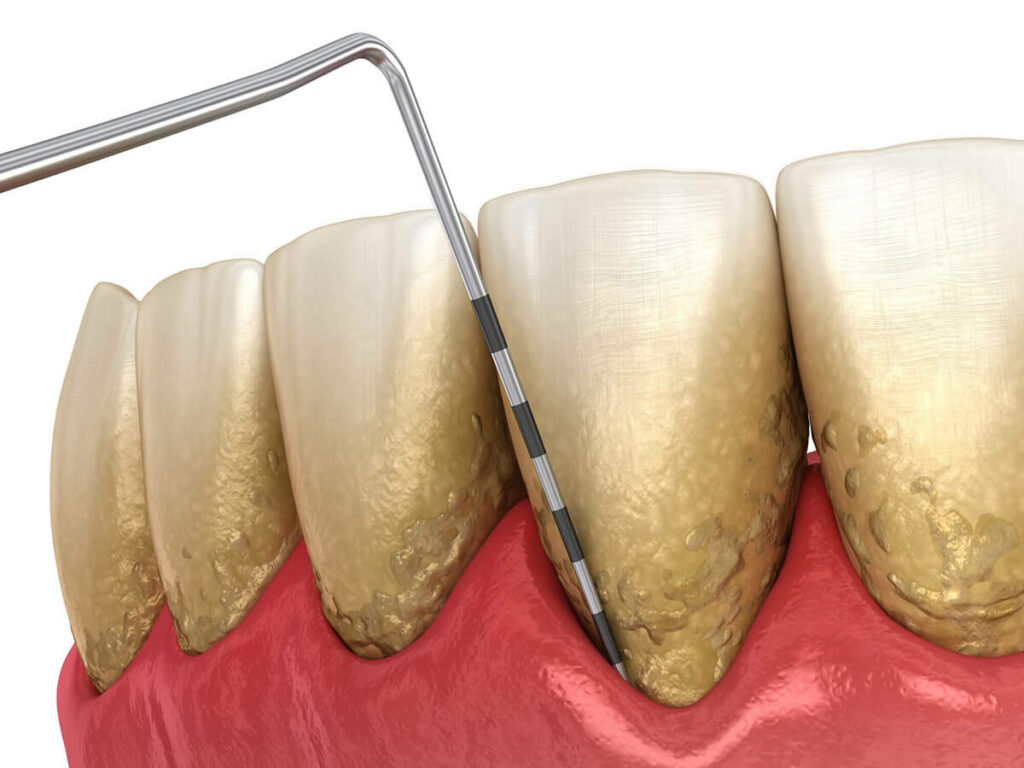 measuring periodontal disease